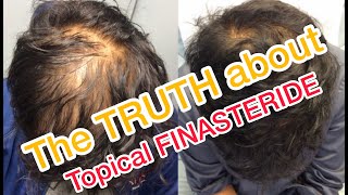 Topical Finasteride  Minoxidil results after 6 Months [upl. by Bascio]