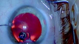 ICL Explantation  Senile Cataract  Nanolaser  Drmed AmirMobarez Parasta  MUNICH EYE [upl. by Enniotna]