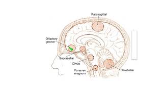 Meningiomas Signs Symptoms and Advanced Treatment Options [upl. by Christoforo]