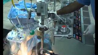 Heart Lung Machine Setting up the extracorporeal circulation [upl. by Tonneson]