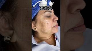 Queratosis Seborreica [upl. by Ayadahs569]