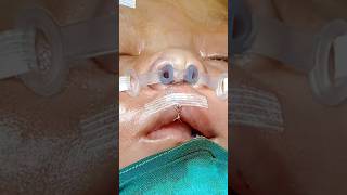 Cleft Lip and Nose Repair  How It Looks Immediate After Surgery  Dr Parit Ladani [upl. by Hardunn220]