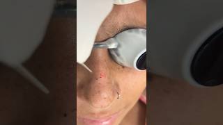 Laser treatment for Freckles  Freckles  Dark spots  lasertreatment [upl. by Carolina]