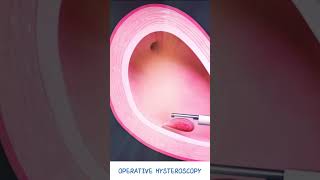 Operative Hysteroscopy  Fibroid amp Polyp removal  Hysteroscopic polypectomy  Types of Hysteroscope [upl. by Fairlie550]