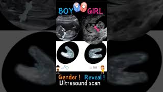 Fetus Ultrasound॥Baby Boy vs Baby Girl॥ baby scan pregnancy fetal [upl. by Sined]