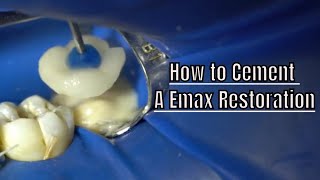 How to Lute a Emax Restoration  Crown [upl. by Nednyl]