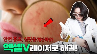 안면홍조실핏줄 얼굴 톤업까지 되는 엑셀V 레이저 알려줄게 [upl. by Gahl]