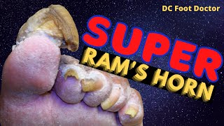 Super Rams Horn Toenail Super Challenging [upl. by Hgielah729]