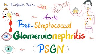 Acute PostStreptococcal Glomerulonephritis APSGN Nephritic Syndrome Kidney PathologyNephrology [upl. by Wesa]