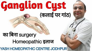 Ganglion cyst कलाई पर गाँठ  Best Homeopathic treatment without surgery [upl. by Lynus]