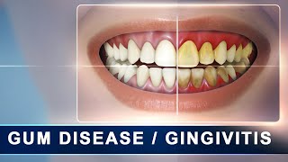 Gingivitis  Treatment of periodontal disease  Scaling and root planing  Tartar [upl. by Oiramej]