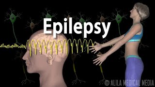 Epilepsy Types of seizures Symptoms Pathophysiology Causes and Treatments Animation [upl. by Burroughs]