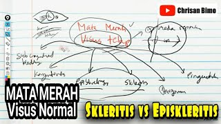 Mata Merah Visus Normal Skleritis vs Episkleritis Skleritis Difusa Nodusa Necroticans Perforans [upl. by Hedley913]