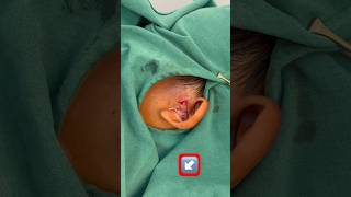 preauricular sinus abscess shorts abcess [upl. by Suoiradal528]