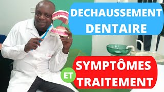 Le traitement de déchaussement des dents comment trouver la solution au déchaussement dentaire [upl. by Aggi]