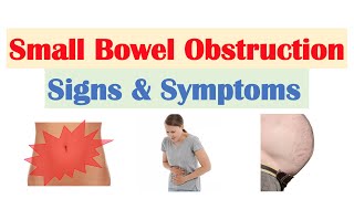 Small Bowel Obstruction SBO Signs amp Symptoms amp Why They Occur [upl. by Luehrmann]