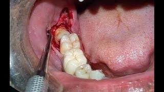 Surgical Extraction of Horizontally Impacted Mandibular Right 3rd Molar Case By Dr Akash Akinwar [upl. by Sarena922]