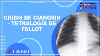 Crisis de Cianósis Tetralogía de Fallot  Telecapacitación INSN [upl. by Elysia]