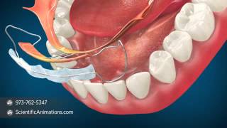 Orthodontic Procedures  Minor Tooth Movement [upl. by Britt]