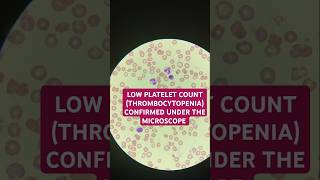 Thrombocytopenia low platelet confirmed under the microscope thrombocytopenia plateletcount [upl. by Rochus]