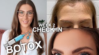 2 Weeks After Botox  Daily updates amp results  Fixing Spock Eyebrows  Botox Before and After [upl. by Cruickshank]