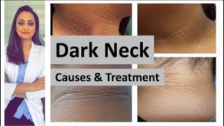 dark neck  causes treatment  Home remedies  Dermatologist Dr Aanchal Panth [upl. by Redan666]