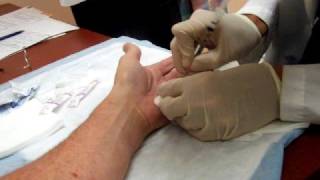 Dupuytrens Contracture  8 minute Cure [upl. by Laverna]