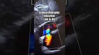 Patent foramen ovale echocardiography [upl. by Bette-Ann]