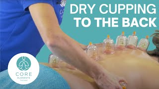 Cupping  What is it and how is it used in our Physical Therapy clinic [upl. by Aloz]