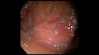 Gastritis withcompression in mid oesophagus [upl. by Ullman]