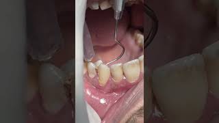 Dental problem of food impacts in deep caries dentist [upl. by Asel]