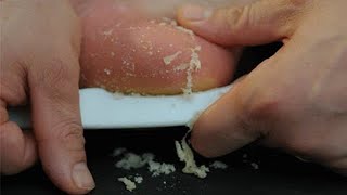 Proven Callus and Corn Treatment in 1 Minute Try It Just once per week [upl. by Asyen951]