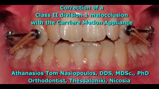 Class II Correction with the Carriere  Athanasios Tom Nasiopoulos [upl. by Ruthven]