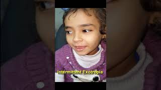 Intermittent Exotropia [upl. by Brindell999]