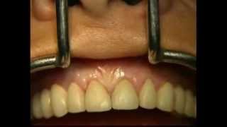 Gingival Surgery  Internal Bevel [upl. by Pratte]