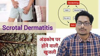 अंडकोष पर होने वाली खुजली का कारण  Part 1 Scrotal Dermatitis  Scrotal Eczema scrotaldermatitis [upl. by Lemaceon]