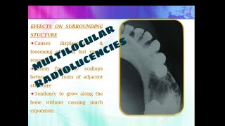 MULTILOCULAR RADIOLUCENCIES OF THE JAW [upl. by Wojcik545]