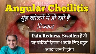 Angular Cheilitis Cause Symptoms Risk Facors and Treatment [upl. by Kenton833]