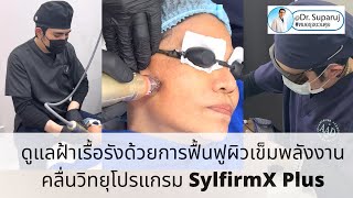 รักษาฝ้า ด้วยการฟื้นฟูผิวด้วยการใช้ เข็มพลังงานคลื่นวิทยุโปรแกรม SylfirmX Plus [upl. by Annaehr]