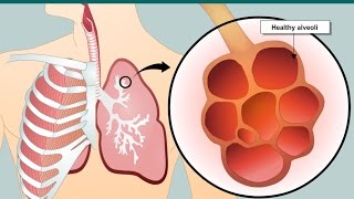 COPD and emphysema [upl. by Gottlieb443]