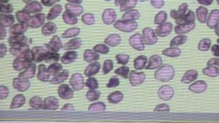 Peripheral blood smear of Babesia in an anemic poodle [upl. by Warwick]