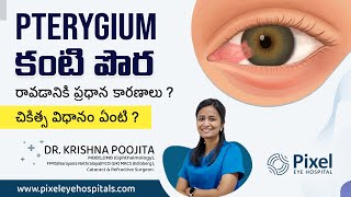 Pterygium causes and treatment  Treatment for Pterygium  Dr krishna Poojita  Pixel eye hospital [upl. by Inor898]