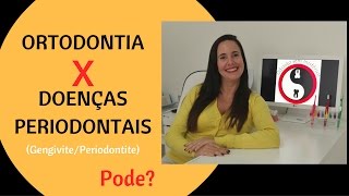 Ortodontia X Doenças Periodontais [upl. by Neelyahs381]