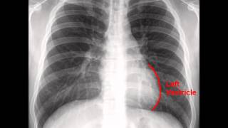 Chest XRay CXR Analysis in a Nutshell [upl. by Adnorahc]