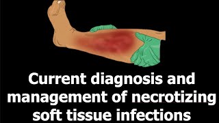 Current diagnosis and management of necrotizing soft tissue infections [upl. by Davidoff199]