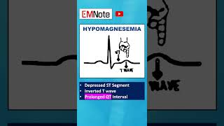 Electrolytes ECG Changes medical doctor nursing [upl. by Eidorb655]