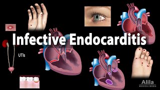 Infective Endocarditis Animation [upl. by Eira]