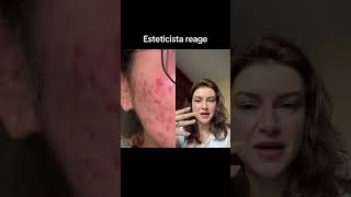 Esteticista reage a adesivo hidrocoloide [upl. by Gerald]