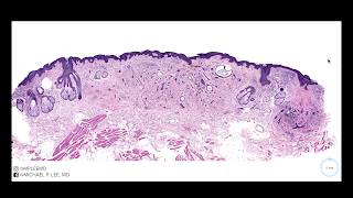 Desmoplastic Trichoepithelioma explained by a dermatopathologist Stain Summary in description [upl. by Hasile561]