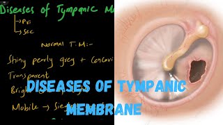 Diseases Of Tympanic Membrane [upl. by Lehcem]